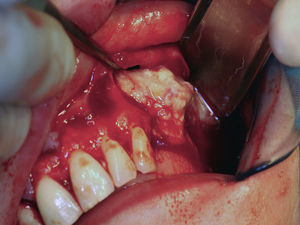 Removal of cystic lesion.