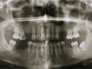 Panoramic radiograph (one-year follow-up – no recurrence of the radicular cyst).