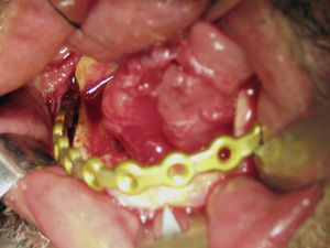 Placa de reconstrução mandibular de titânio do sistema 2,4 (Osteomed®, Dallas, EUA), previamente moldada, aplicada «em ponte» sobre o defeito, com aparafusamento nas zonas sãs limitantes do defeito.