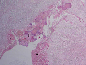 Histologia (H‐E ×10): proliferação epitelial ameloblástica em cordões (A) adjacente a áreas de odontoma composto (B) na parede do quisto.