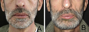 (A) Contorno mandibular antes da excisão tumoral e (B) 3 meses após reconstrução mandibular.