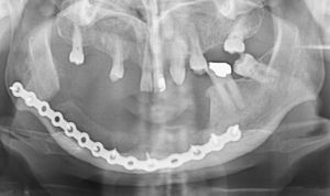 Ortopantomografia 6 meses após reconstrução da mandíbula com enxertos corticoesponjosos colhidos de ambas as cristas ilíacas anteriores.