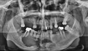 Ortopantomografia: lesão osteolítica da mandíbula com radiopacidades em conglomerado no seu interior. Rizólise de 44 e 45.
