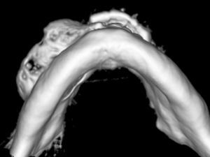TAC 3D: mandíbula vista inferior; à direita há expansão da cortical externa com áreas de aparente perfuração.