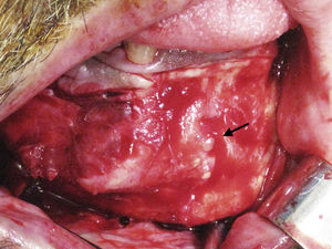 Exposição da lesão mandibular após descolamento mucoso supraperióstico. Evidente abaulamento da cortical externa com dentículos perfurando a cortical externa (seta).