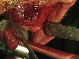 Osteotomia marginal do rebordo basilar com serra recíproca.