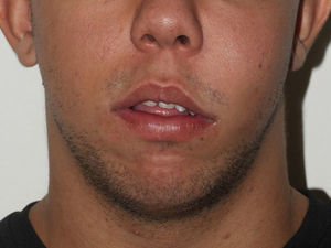 Preoperative appearance of severe swelling in left face.