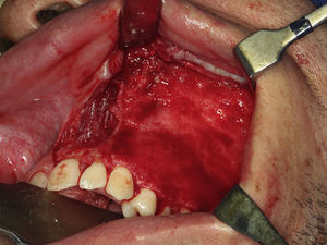 Intraoperative photograph showing conservative bone shaving after the osteotomies in the first case.