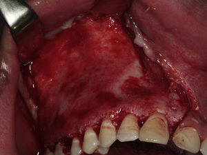 Intraoperative photograph showing conservative bone shaving after the osteotomies in the second case.