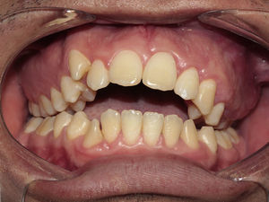 Appearance at two years’ follow-up showing intra oral view.