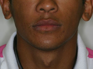 Appearance at one year’ follow-up showing symmetry of the face.