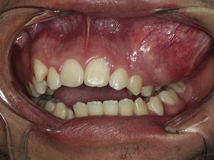 Presence of maxillary swelling and dental malocclusion.
