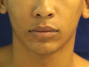 Preoperative view of enlargement of the right midface.