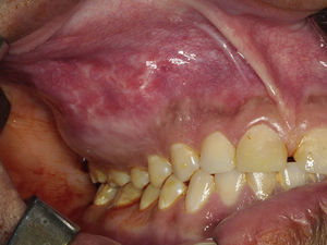 Presence of maxillary enlargement and satisfactory dental occlusion.