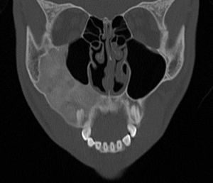 Preoperative CT scans, coronal view of second case.