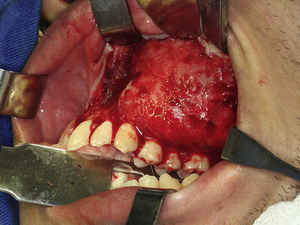 Intraoperative photograph showing conservative bone shaving before the osteotomies in the first case.