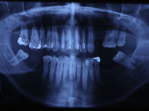 Preoperative panoramic radiography.