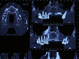 Computerized axial tomography-frontal and axial slices.
