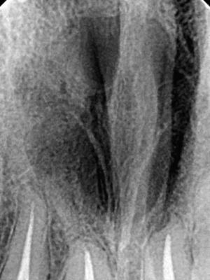 Periapical radiography 12 month