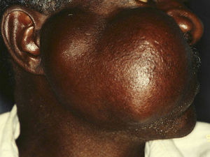 Lesion with a binodular surface, involving the cheek and the parotid region.