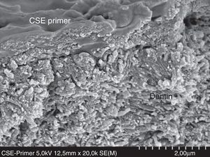 FESEM micrograph of an interface formed with Clearfil SE Bond primer (Kuraray) applied on dentin following the manufacturer's instructions. A zone of mild dentin decalcification can be observed in the monomers enveloping HAp and collagen fibers. Original magnification=×20,000.