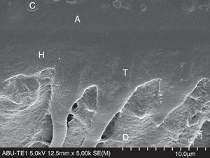 FESEM micrograph of a resin–dentin interface formed with All-Bond Universal Adhesive (Bisco Inc.), applied in etch-and-rinse mode. Original magnification=×5000. A=adhesive; C=composite; D=dentin; H=hybrid layer; T=resin tag.