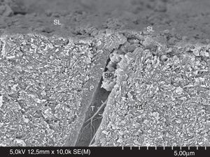 FESEM micrograph of smear layer and a smear plug. Original magnification=×10,000. SL=smear layer; SP=smear plug; Int=intertubular dentin; P=peritubular dentin; T=dentinal tubule.