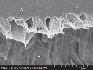 FESEM micrograph of resin–enamel interface formed with Peak Universal Bond (Ultradent) under the etch-and-rinse mode, after treatment with 6N HCL. Original magnification=×5000. A=adhesive; ET=enamel tags formed by enamel crystallites that were wrapped by the adhesive; E=enamel.