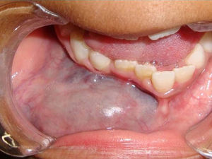 Initial photography (intraoral dental malposition).
