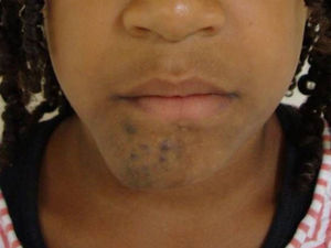 Extraoral photography after a 3-year follow-up period (correction of facial deformity).