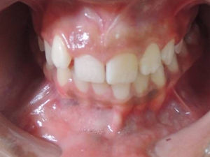 Intraoral photography after a 3-year follow-up period (natural alignment of teeth).