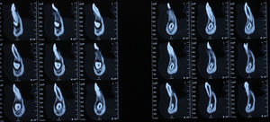 Computerized axial tomography – sagittal slices.