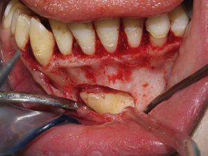 Surgical tooth exposure.