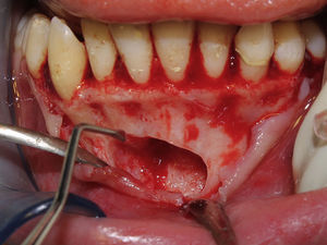 Surgical tooth removal.