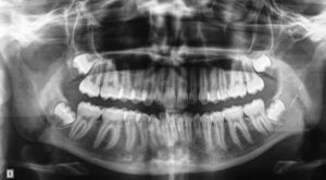 Control panoramic radiograph 12 months after tooth removal.