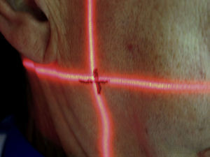 Lateral view of the head. Laser marks coincided with pen marks.