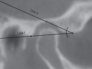 Sagittal view of the right condyle. Angle formed between a straight line, passing through A and B (line I); a straight line passing through C and A (line II).