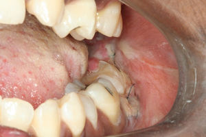 Aspecto da região da tentativa de exodontia e fratura mandibular.