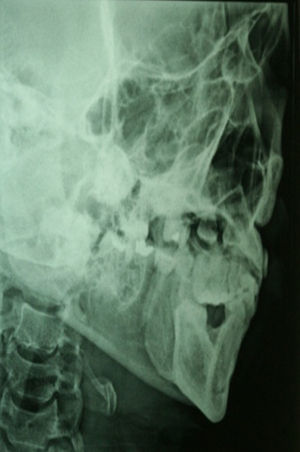 Incidência radiográfica lateral oblíqua de mandíbula que evidencia o traço de fratura.