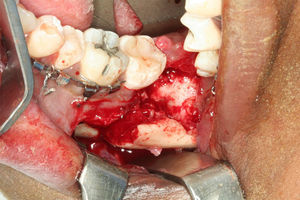 Fratura acessada e alvéolo do dente 38 já removido. Note o deslocamento significativo dos cotos.