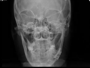 Radiografia posteroanterior de mandíbula, pós‐operatório imediato, que apresenta boa redução e fixação da fratura.