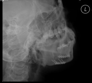 Radiografia lateral oblíqua de mandíbula lado esquerdo, pós‐operatório imediato, que apresenta boa redução e fixação da fratura.