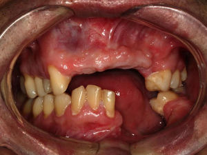 Intraoral view of the left mandibular body defect.