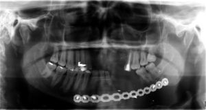 Panoramic radiograph view of the left mandibular body defect.