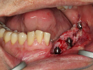 Morse tapered implants and abutments after the surgery.
