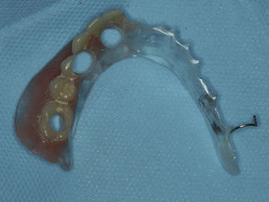 Provisional prosthesis before titanium cylinders incorporation.