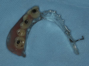 Provisional prosthesis after titanium cylinders incorporation.