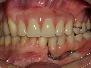 Intraoral view six months after placement of dental implants.