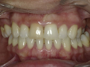Fotografia inicial – descoloração do dente 11.