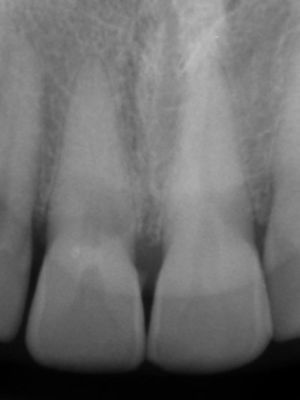 Radiografia inicial, evidenciando calcificação do canal radicular do dente 11.